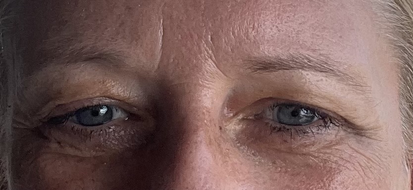Schnipp-schnapp,... ab: Augen-Lid OP: so sah es davor aus