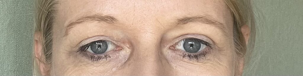 Schnipp-schnapp,... ab: Augen-Lid OP: so sieht es 5 Wochen danach aus